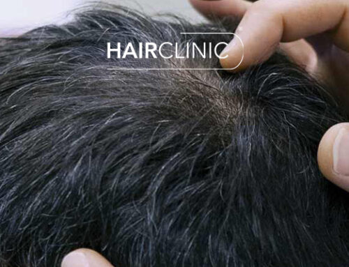 PRP Hairclinic Marseille