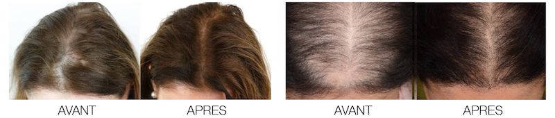 Hairclinic PRP cheveux chez les femmes