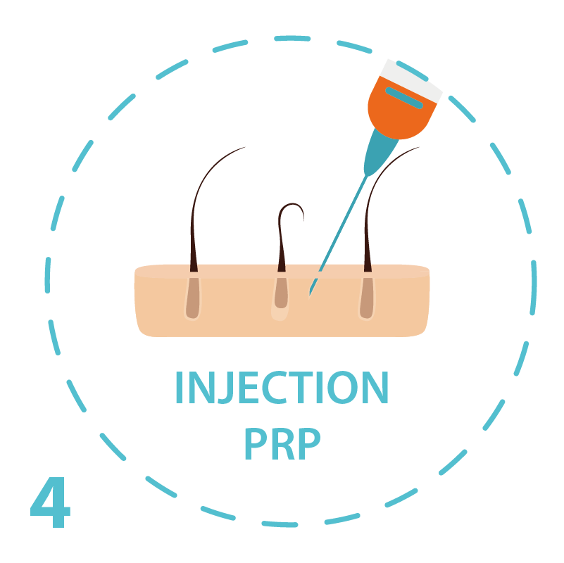 Injections PRP Nice Marseille Cannes Hairclinic