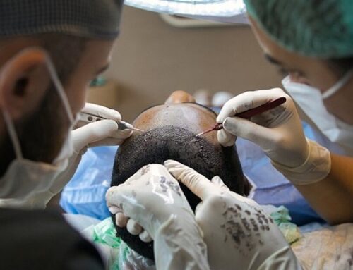 Bénéficier d’une greffe de cheveux par un spécialiste à Marseille