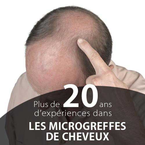 solution perte de cheveux