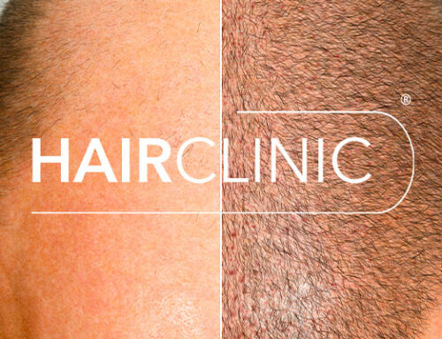 Implants capillaires – Expertise HairClinic sur la FUE
