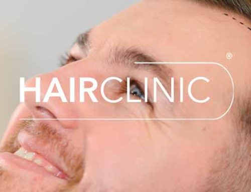 Greffe de cheveux ligne frontale : reconstruire une implantation naturelle