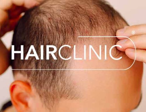 Calvitie Homme à Nice : Quelles solutions contre la chute de cheveux ?
