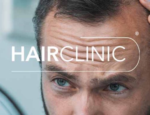Calvitie Homme à Nice : Quelles solutions contre la chute de cheveux ?